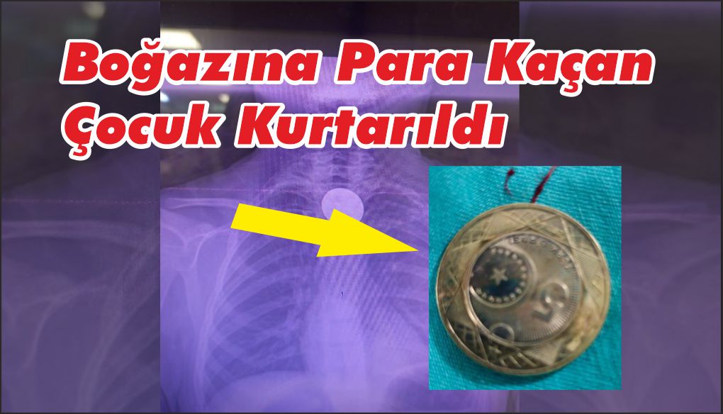 8 Yaşındaki Çocuk 5 Lirayı Yuttu