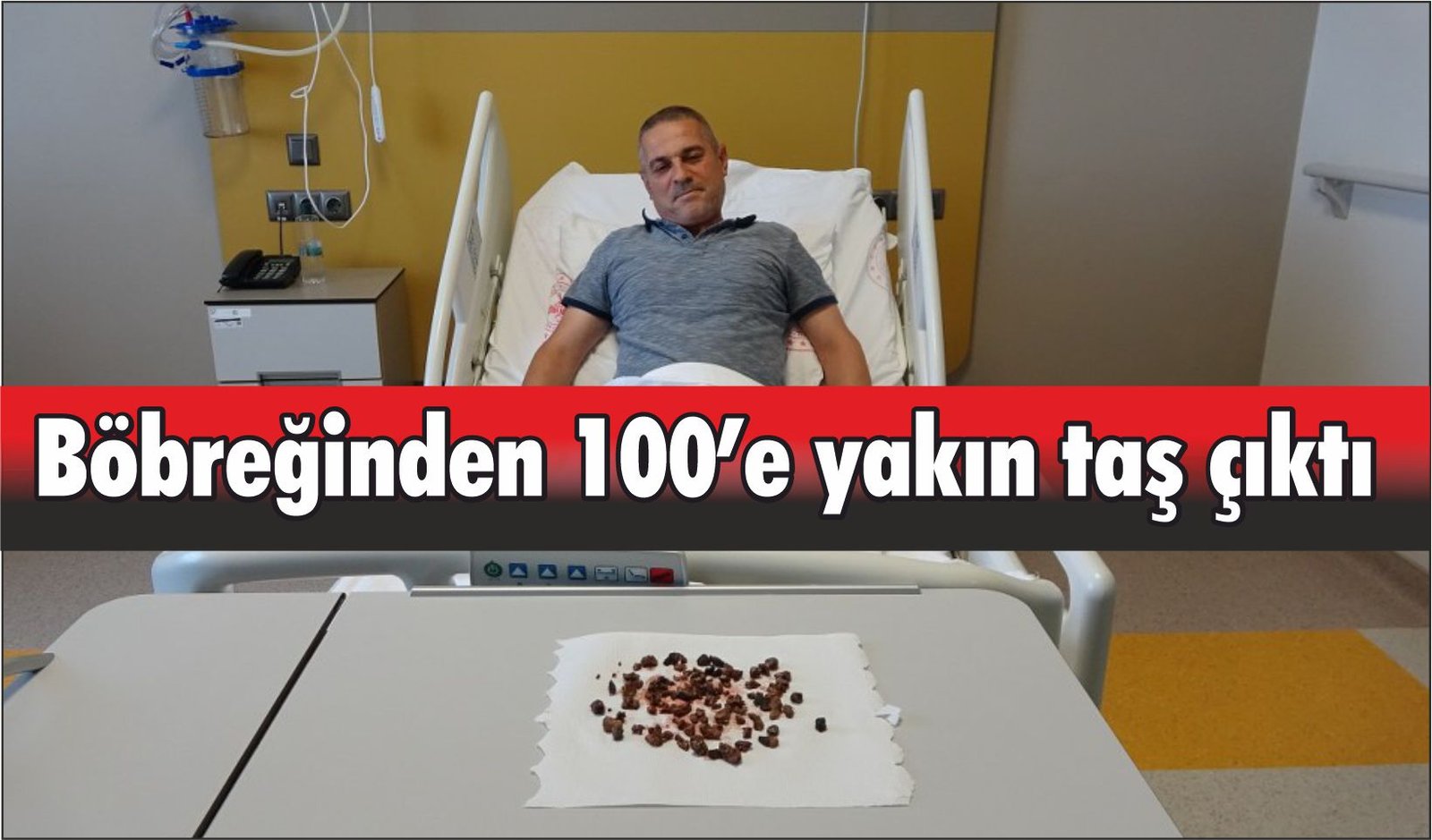 Böbreğinden 100’e yakın taş çıktı