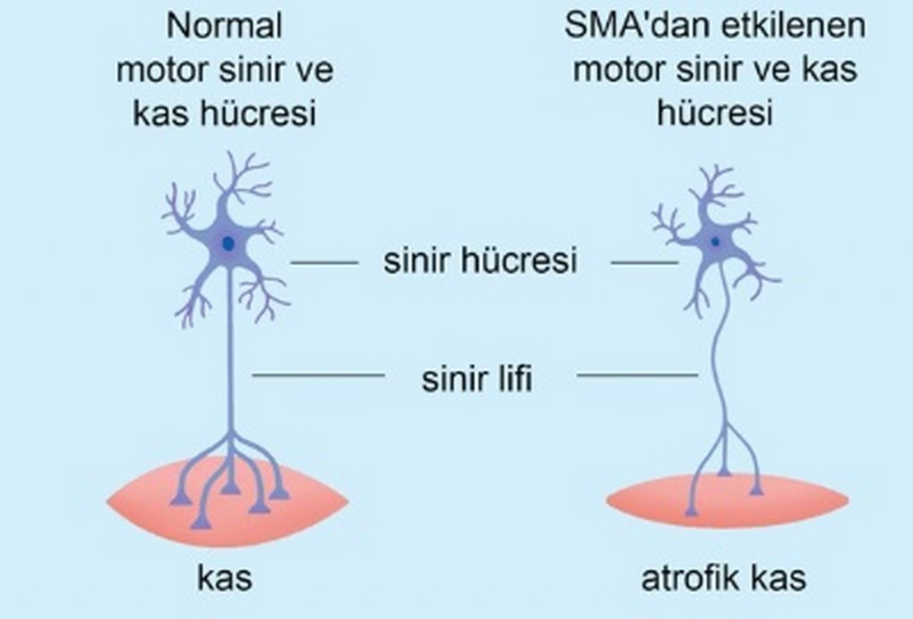 2026'nın ilk yarısında Türkiye kendi SMA ilacını üretecek