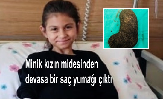 Minik kızın midesinden devasa bir saç yumağı çıktı