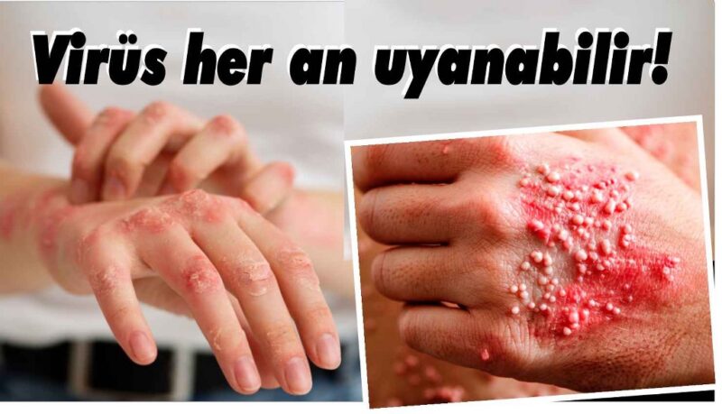 50 yaş üstü için kritik uyarı: Vücudunuzdaki virüs her an uyanabilir!