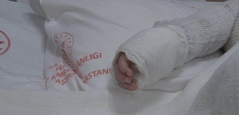 Doç. Dr. Arpacık: “Tüm yanıkların yaklaşık yarısını çocuklar, önlemler almalıyız”